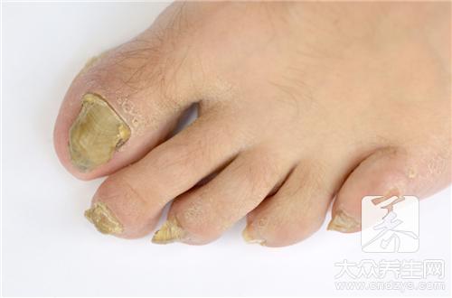 1个脚指甲变黑是什么病