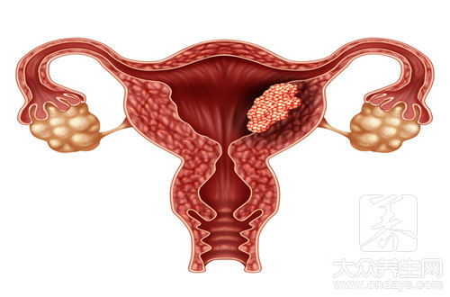 早期子宫内膜癌b超表现