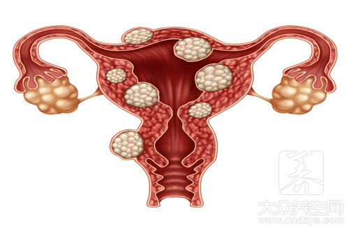 子宫内膜息肉怎么治疗