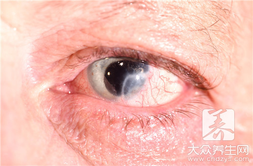 眼睑发炎可以自愈吗