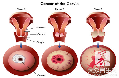 宫颈癌症状月经