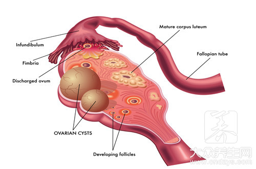 卵巢囊肿是什么原因引起