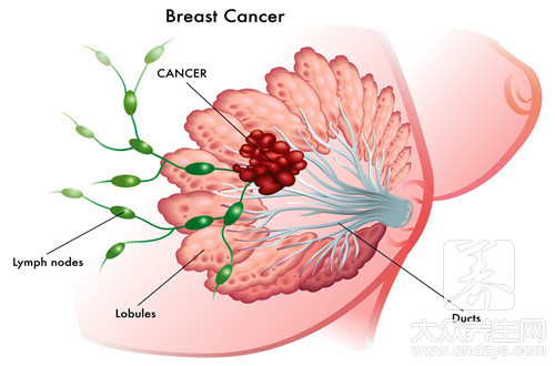 乳腺癌是生气引起的吗