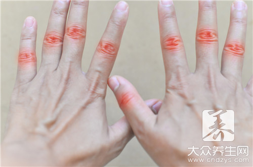 手指滑膜炎什么症状