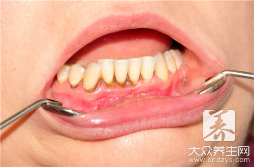 补牙的材料有哪几种_补牙是用什么材料