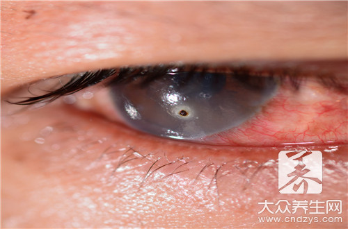 角膜红血丝用什么眼药水