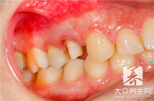填牙齿洞从消炎开始要多久