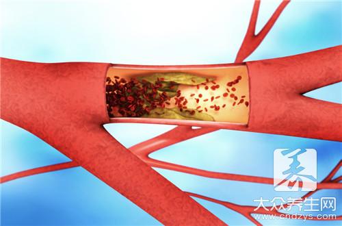  脑血管动脉硬化怎么治有效？