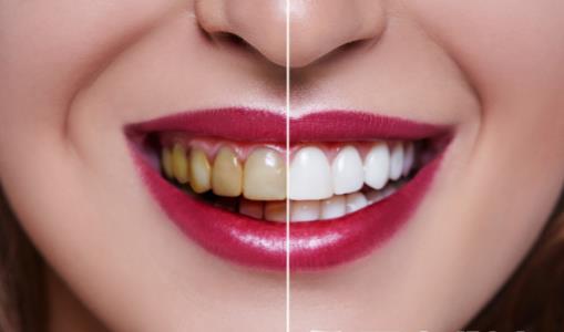 网传美白牙齿偏方鉴定是否靠谱 常见美牙方法推荐