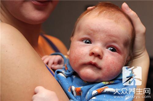 宝宝过敏和湿疹的区别