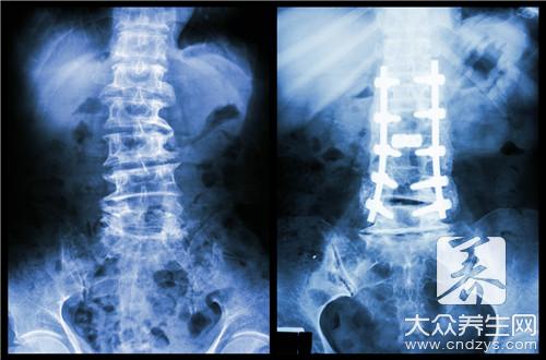股骨颈骨折坏死率，还需定期检查和治疗