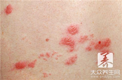 过敏性皮炎湿疹是怎么形成的？