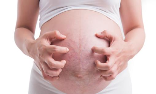 妊娠纹引发引发皮肤出疹 孕期如何改善和预防妊娠纹 