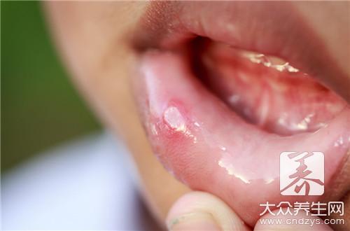 口腔溃疡应该怎么处理呢？