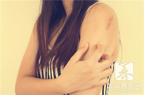 皮肤划痕症有哪些民间治疗方子？