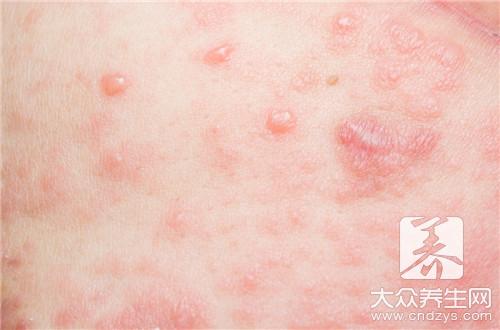 摩擦性湿疹怎么治疗呢？