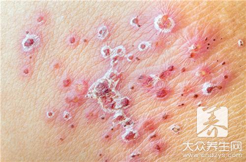 摩擦性湿疹怎么治疗呢？