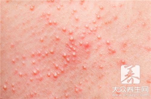 过敏性皮炎湿疹是怎么形成的？