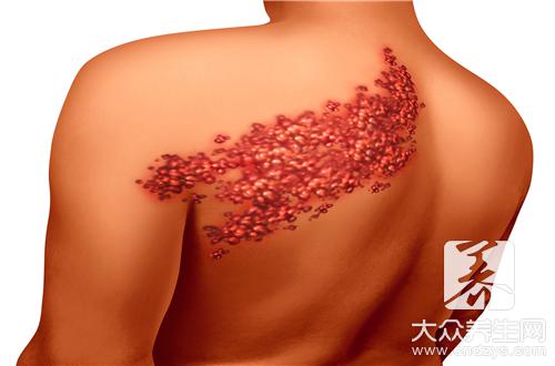 腰部带状疱疹有哪些特点
