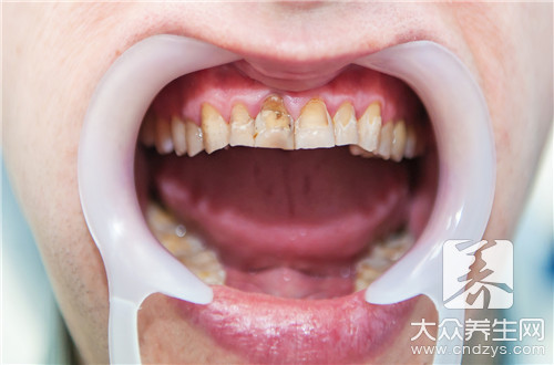 牙齿反颌的矫正步骤