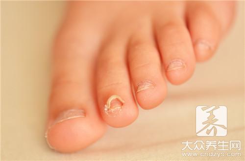 灰指甲的初期症状有哪些?指甲凹凸不平